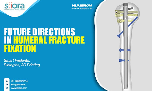 Future Directions in Humeral Fracture Fixation: Smart Implants, Biologics, 3D Printing